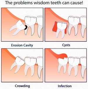 the problems wisdom teeth can cause