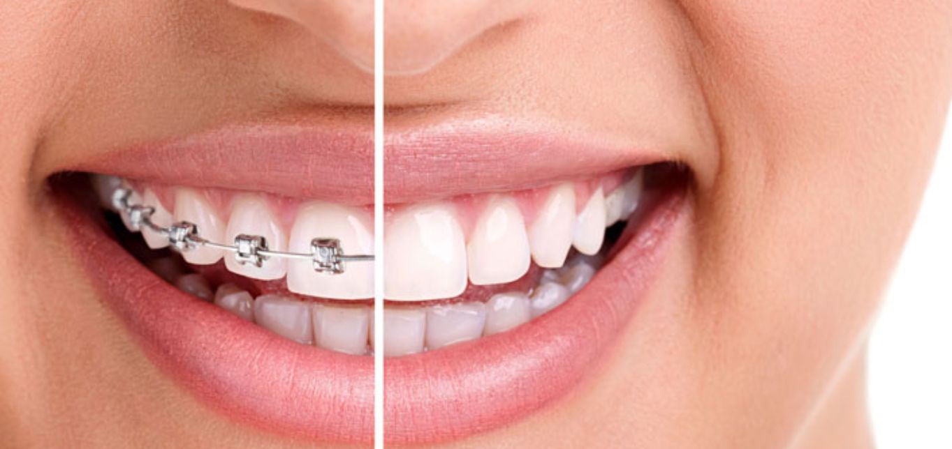 4-dental-health-problems-that-can-be-fixed-by-orthodontic-treatment