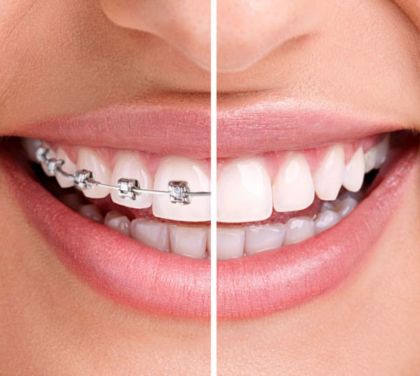 4-dental-health-problems-that-can-be-fixed-by-orthodontic-treatment