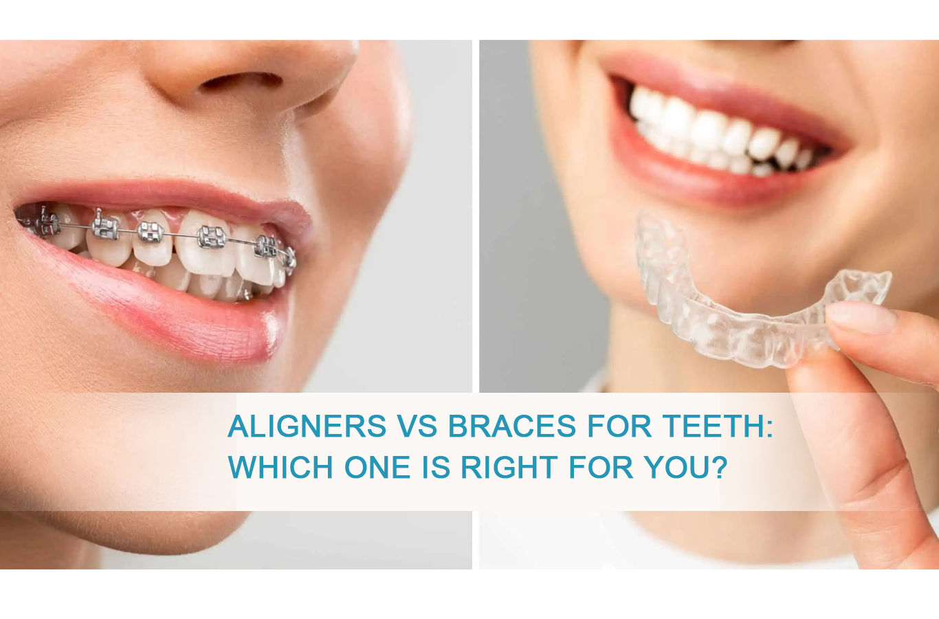 aligners-vs-braces-for-teeth-which-one-is-right-for-you