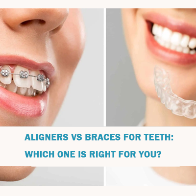 aligners-vs-braces-for-teeth-which-one-is-right-for-you