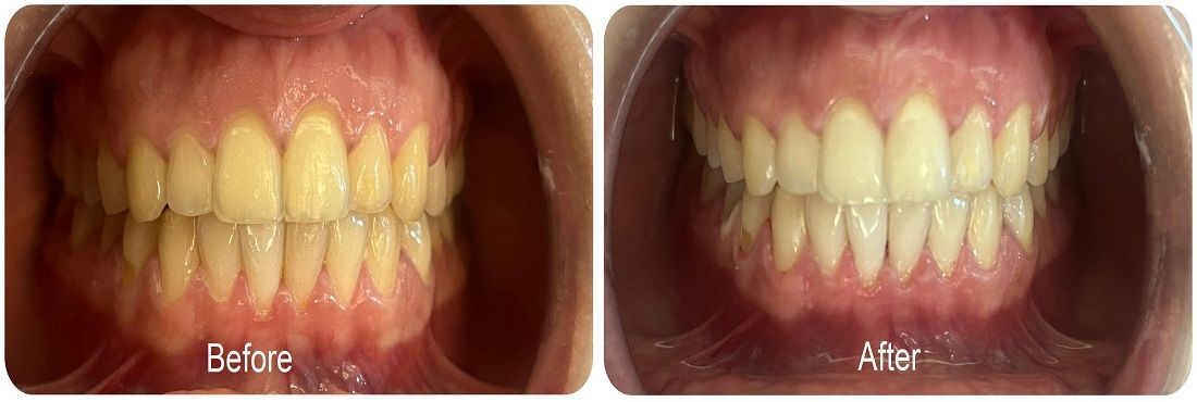 before and after case