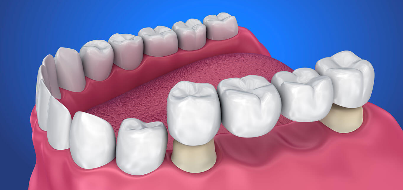 bridging-the-gaps-between-your-teeth