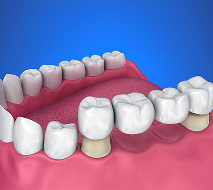 bridging-the-gaps-between-your-teeth