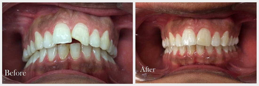 broken tooth before after