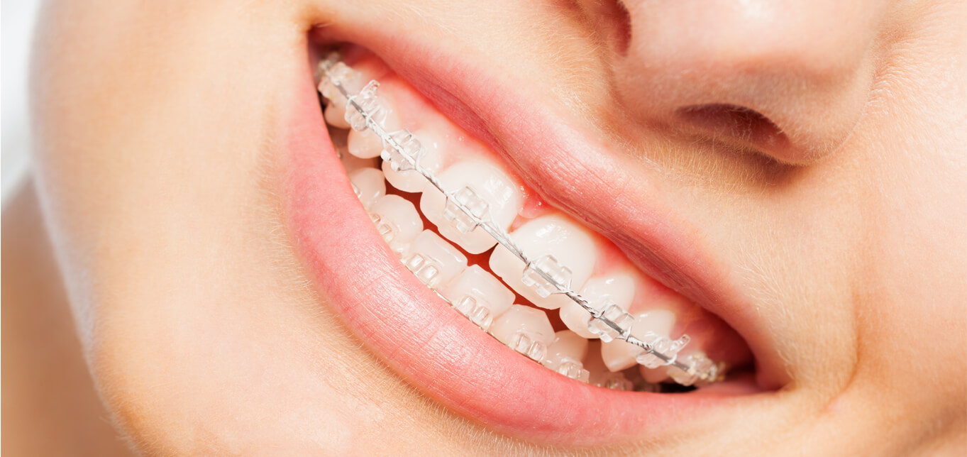 ceramic-braces-an-alternative-to-clear-aligners