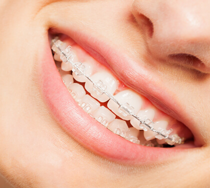 ceramic-braces-an-alternative-to-clear-aligners