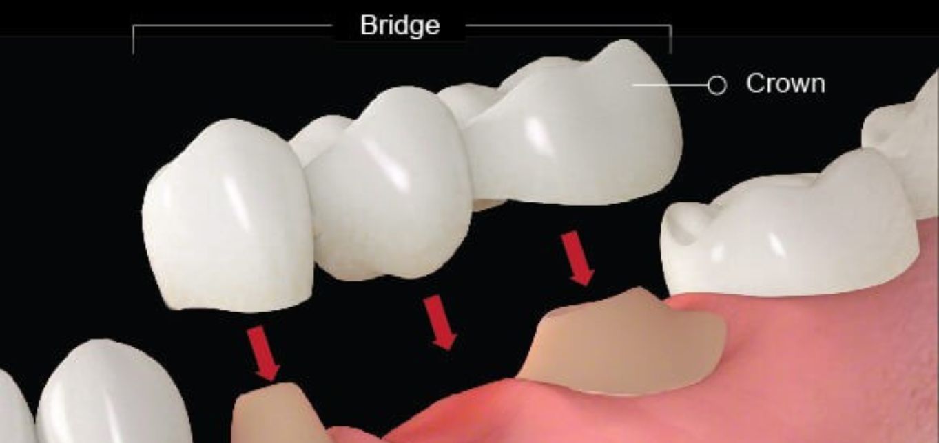 dental-bridges-replacing-your-teeth-with-the-right-way