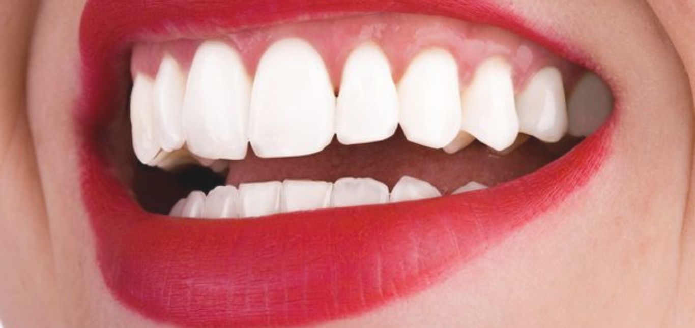 get-pearly-white-teeth-with-teeth-whitening-procedure