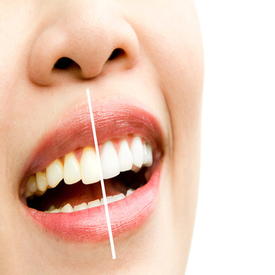 how-much-does-teeth-whitening-cost-a-complete-breakdown