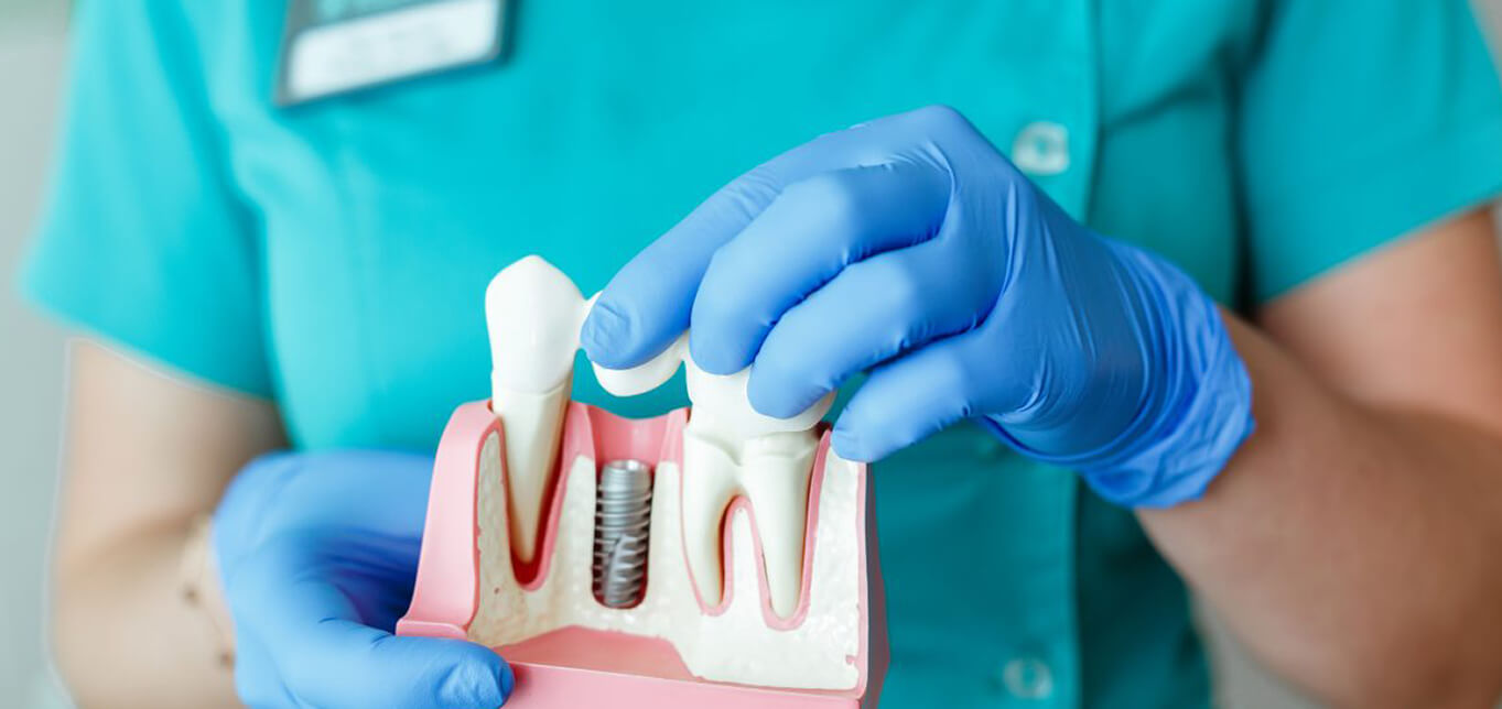 how-to-mentally-prepare-yourself-for-dental-implants