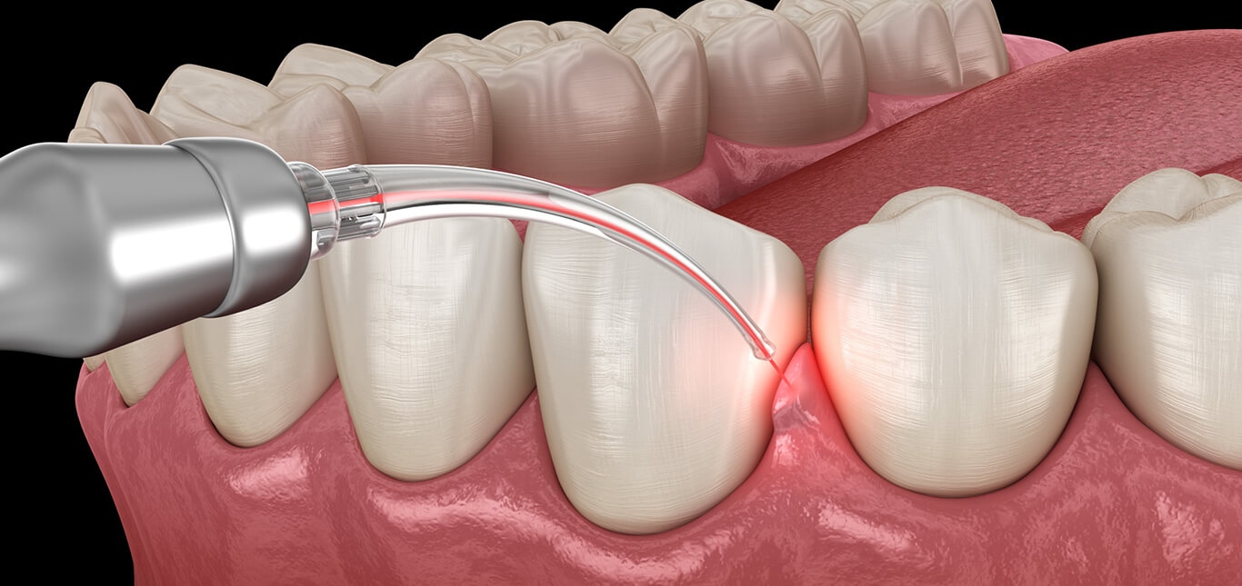 laser-dentistry