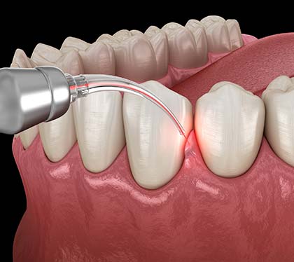 laser-dentistry