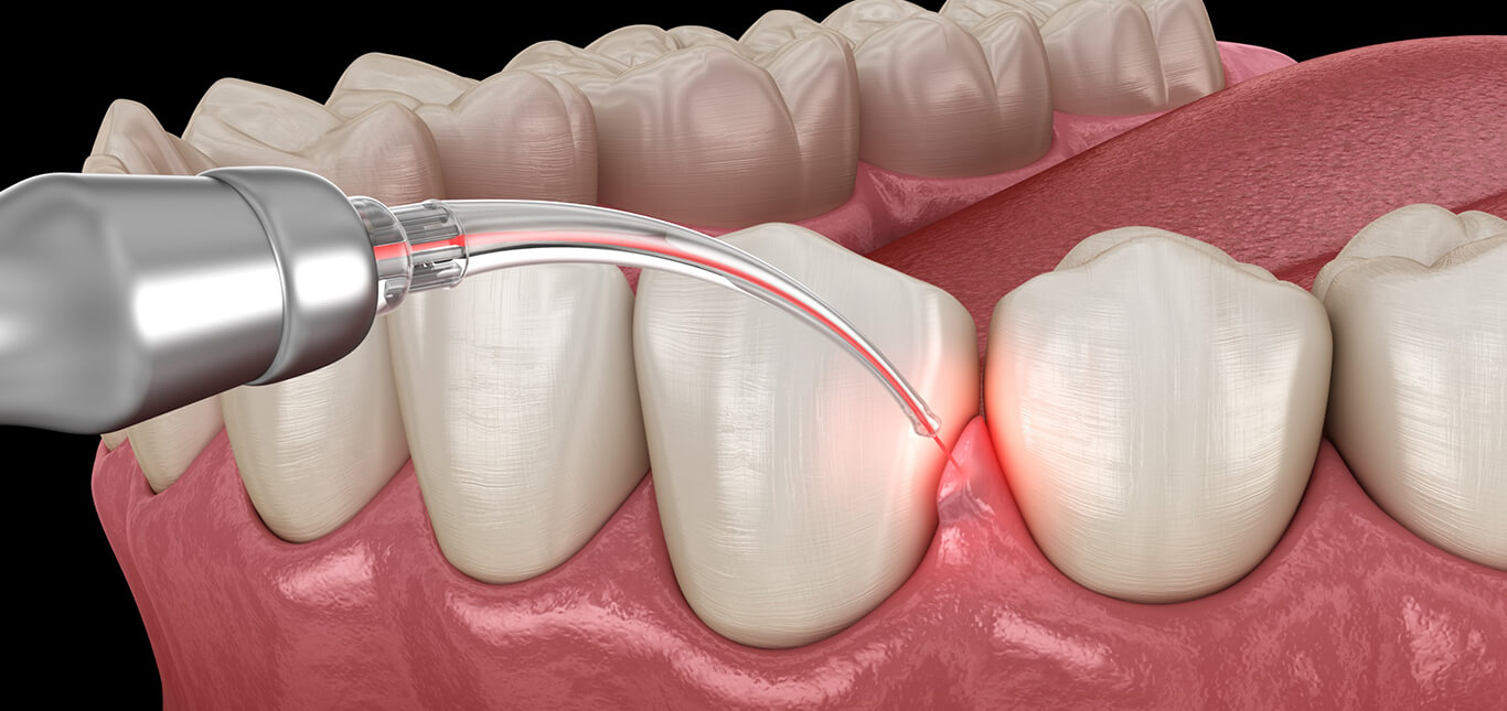 pain-free-laser-dentistry-the-dental-roots