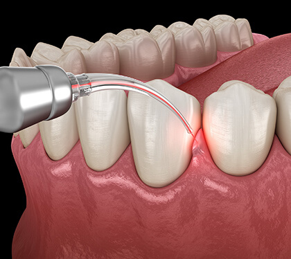 pain-free-laser-dentistry-the-dental-roots