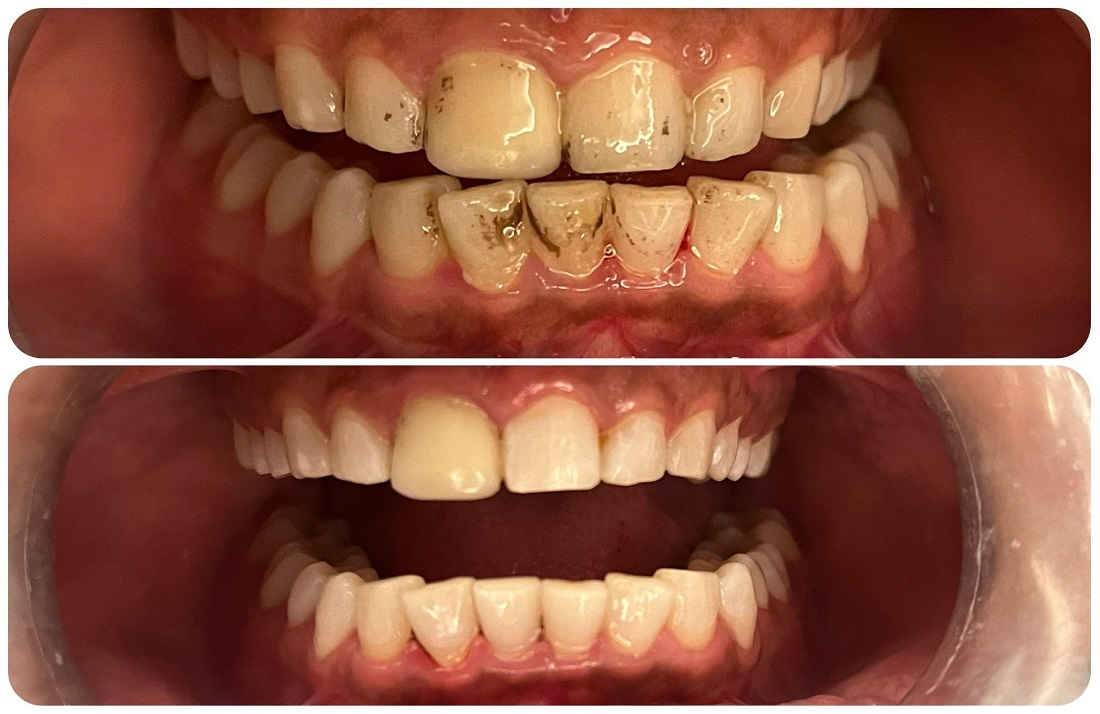 smile makeover before after