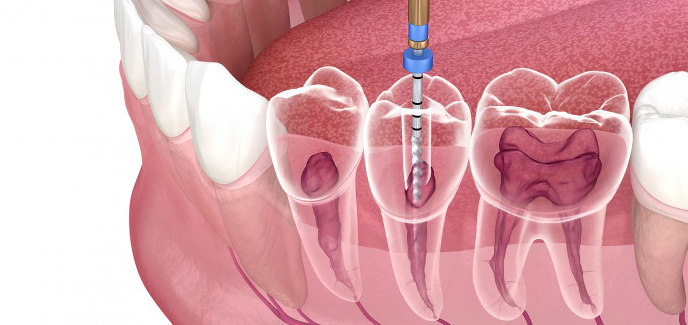 The Ultimate Guide To Finding The Best Root Canal Specialist