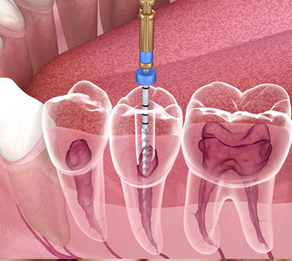 symptoms-of-when-you-need-to-visit-a-root-canal-specialist