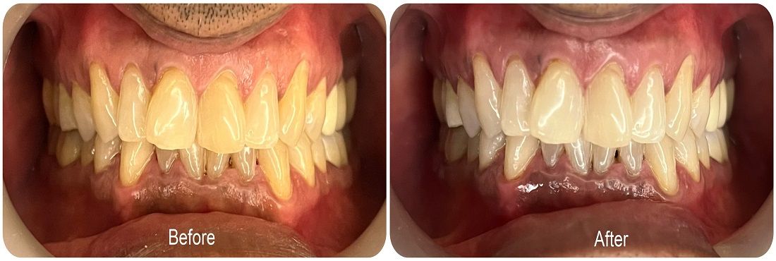 teeth-whitening-near-you