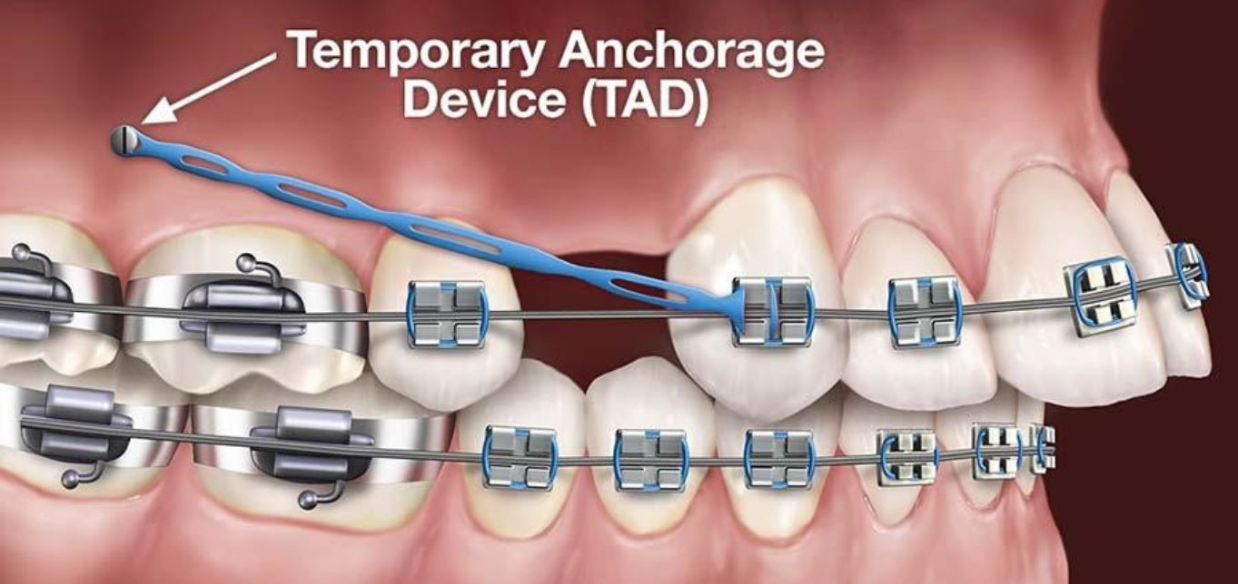 temporary-anchorage-device