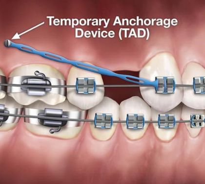 temporary-anchorage-device