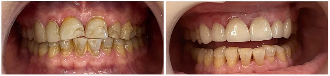 tooth coloured fillings