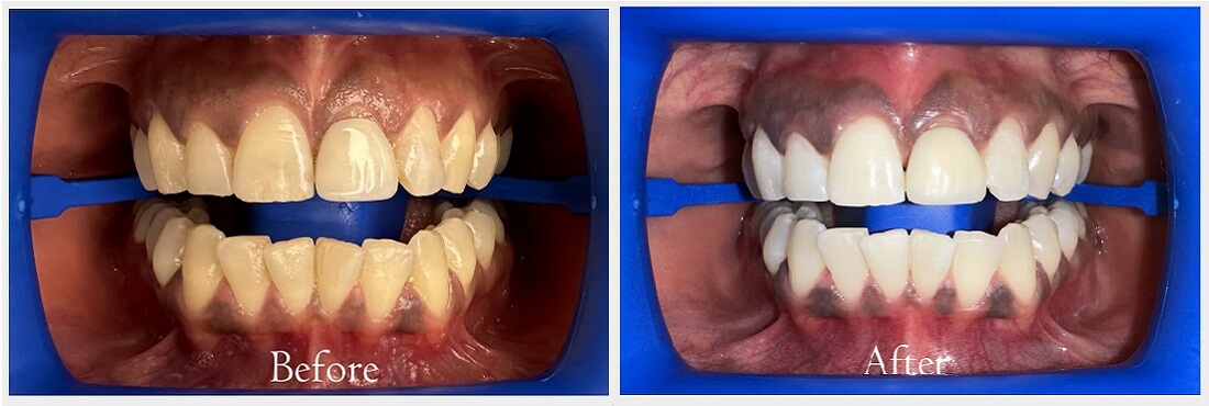 vital bleaching before after