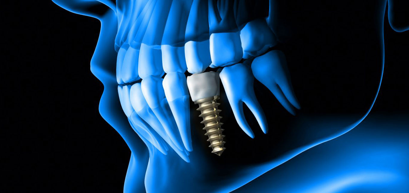 what-is-a-dental-implant-what-are-the-major-advantages-of-this-procedure