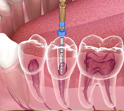 what-steps-are-involved-in-a-root-canal-treatment