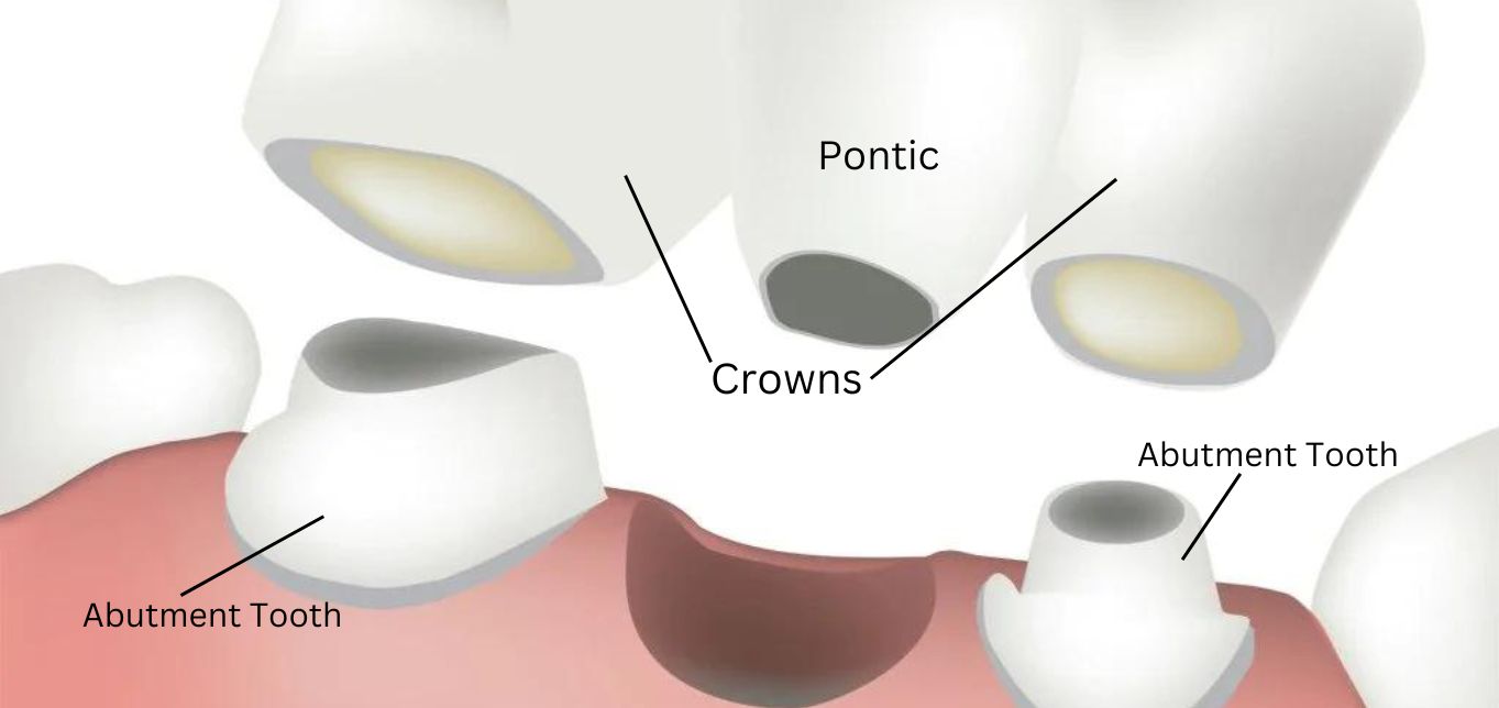 when-do-we-need-dental-bridge-treatment