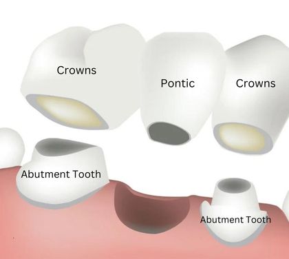 when-do-we-need-dental-bridge-treatment