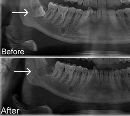 wisdom-tooth-removal