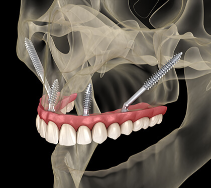 zygomatic-dental-implants