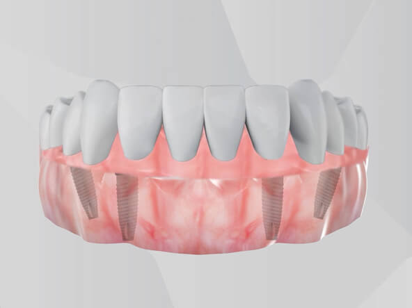 Dental Implants Procedure 