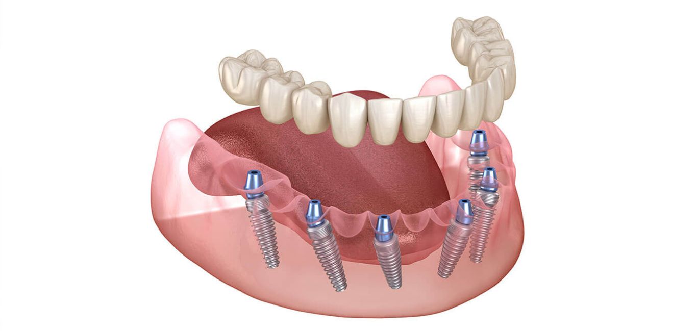 all-on-6-dental-implants