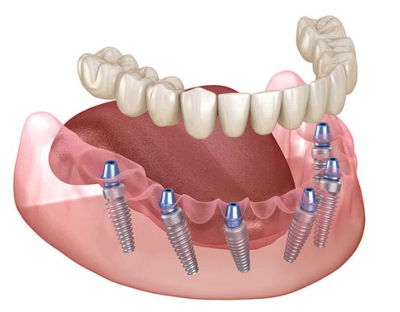 all-on-6-dental-implants