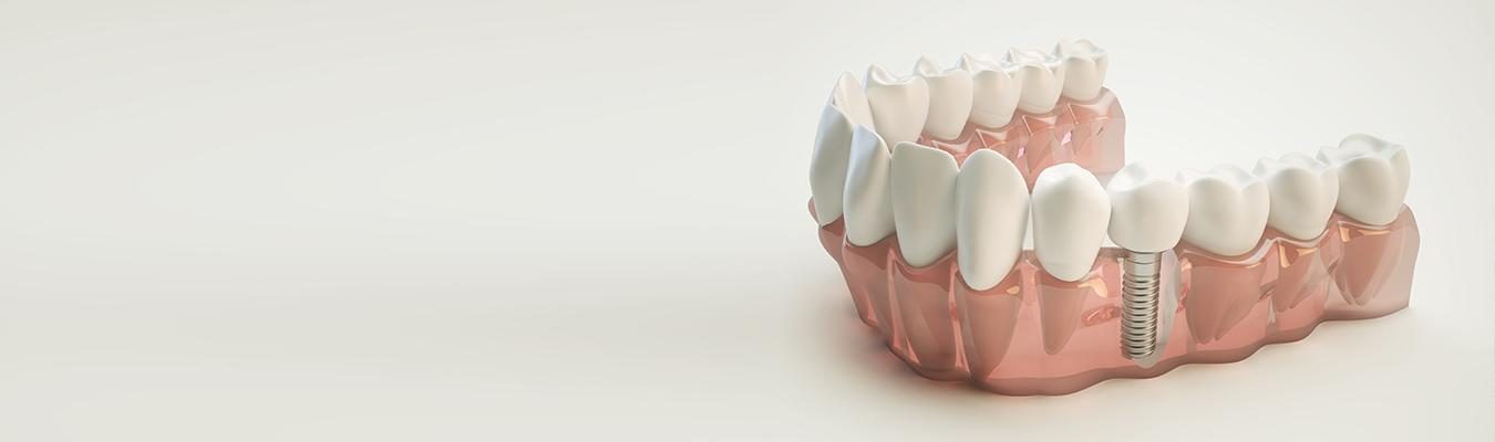 dental-implants-analysis