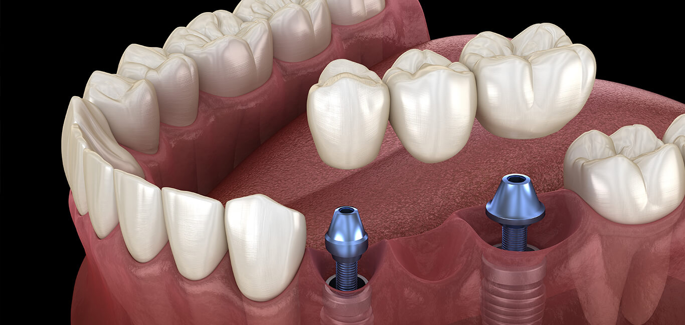dental-implants-in-south-delhi