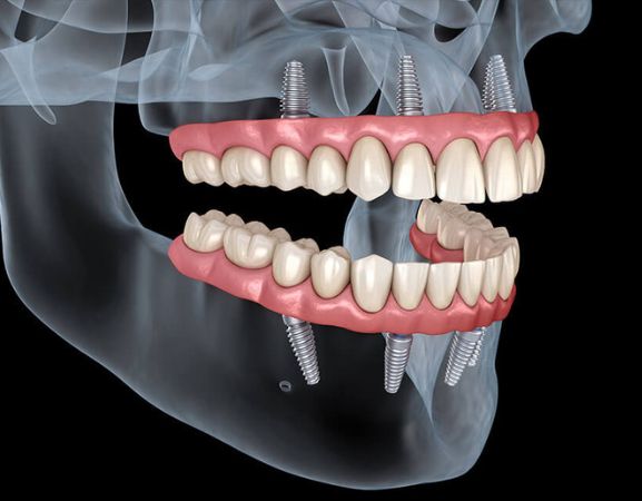 full-mouth-dental-implants