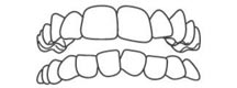 Invisalign