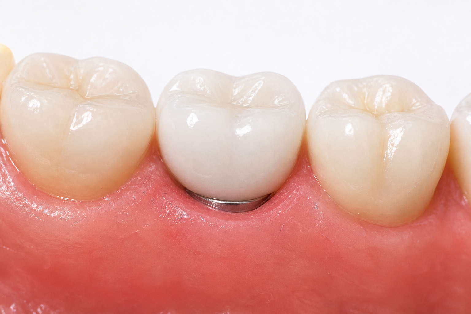 Dental implant lifespan, osseointegration and crown replacement guide