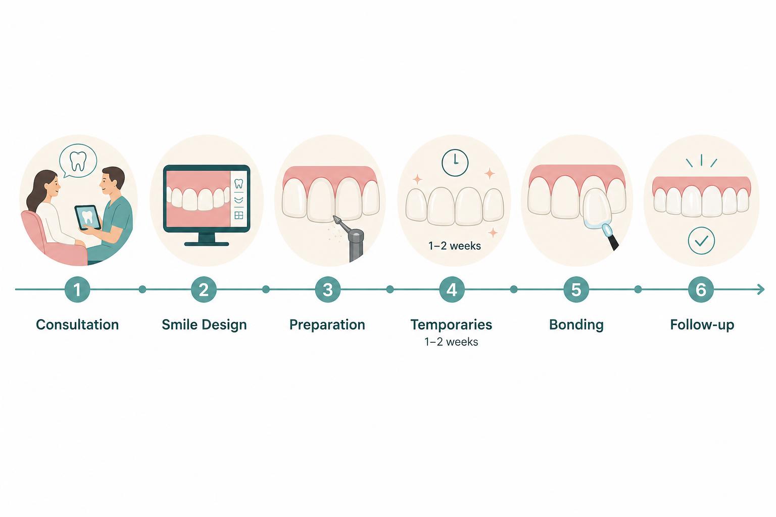Timeline infographic of the veneer treatment journey