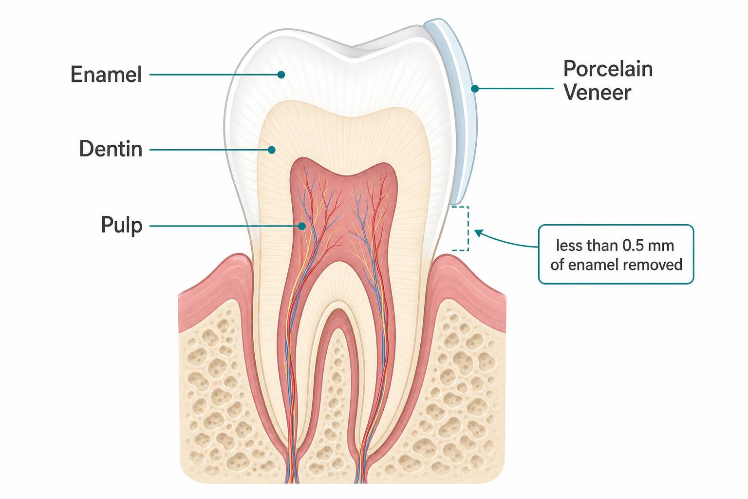 Diagram of tooth anatomy showing enamel, dentin, pulp and a porcelain veneer attached to the front