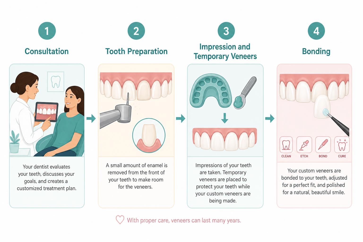 Infographic showing the four steps of the veneer procedure