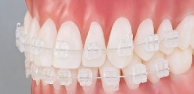 Ceramic Braces: What are They? A Discreet Orthodontic Solution at