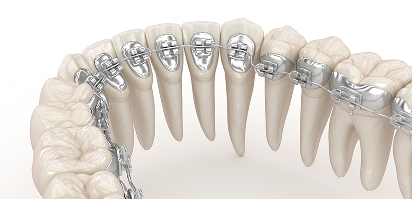 Lingual-Braces