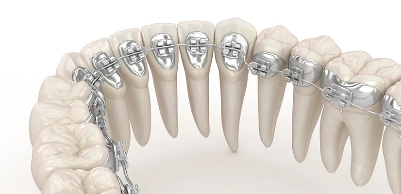Lingual Braces Lingual-Braces