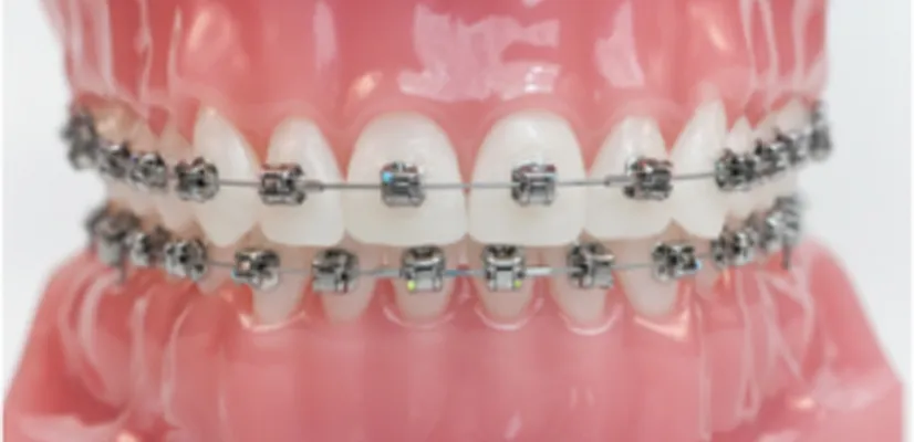 Traditional Metal Braces Metal-Braces