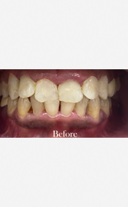 full mouth dental implants in india