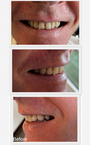 dental implants in india